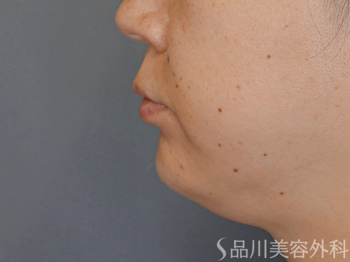 症例NO.71006のAFTER写真