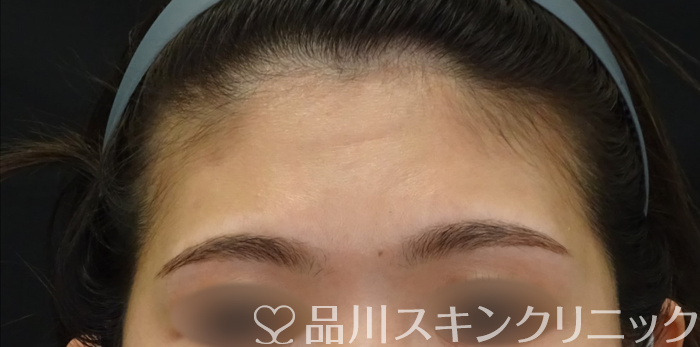 症例NO.69405のBEFORE写真