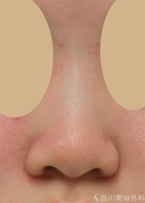 症例NO.27814のBEFORE写真