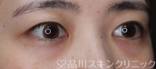 症例NO.70326のBEFORE写真