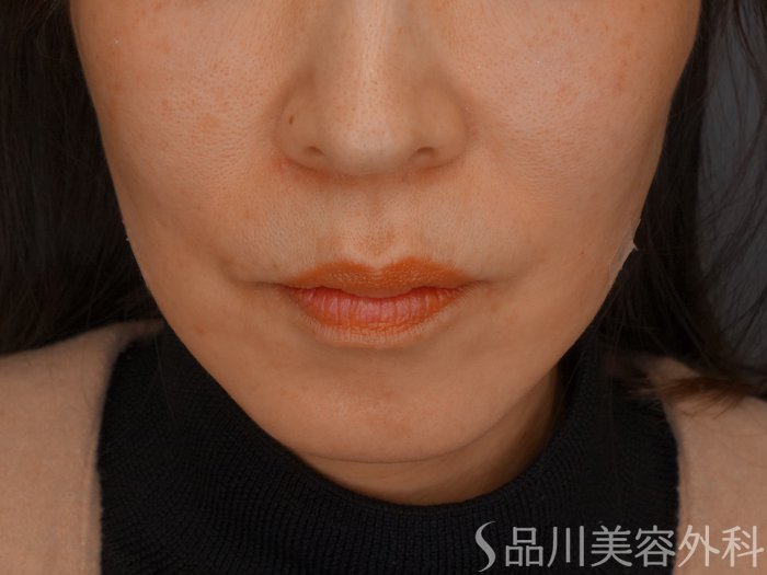 症例NO.69436のAFTER写真