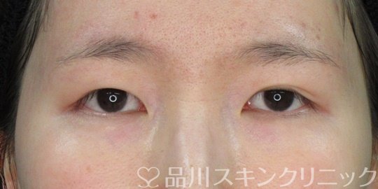 症例NO.73227のBEFORE写真