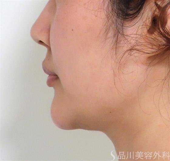 症例NO.38011のBEFORE写真