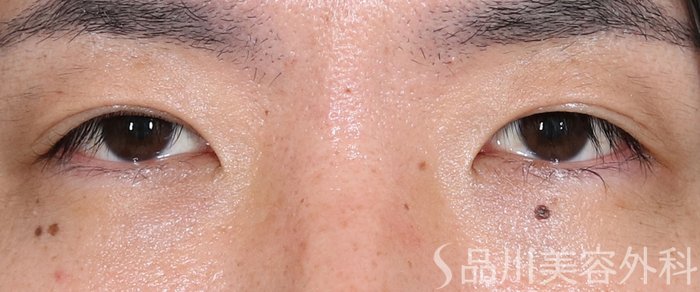 症例NO.70870のAFTER写真