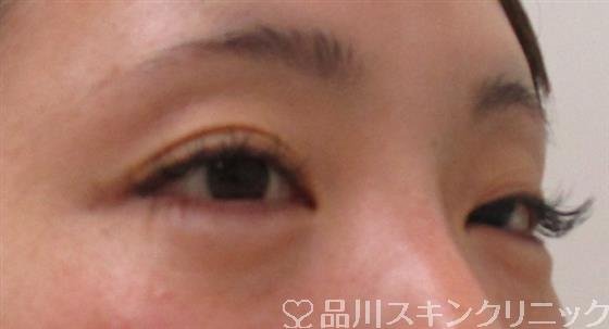 症例NO.41724のBEFORE写真