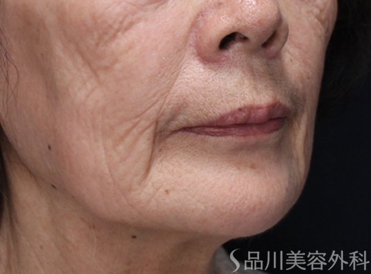 症例NO.74168のBEFORE写真