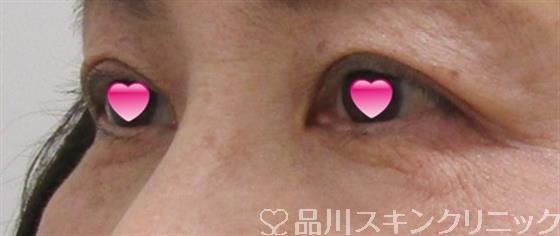 症例NO.41446のAFTER写真