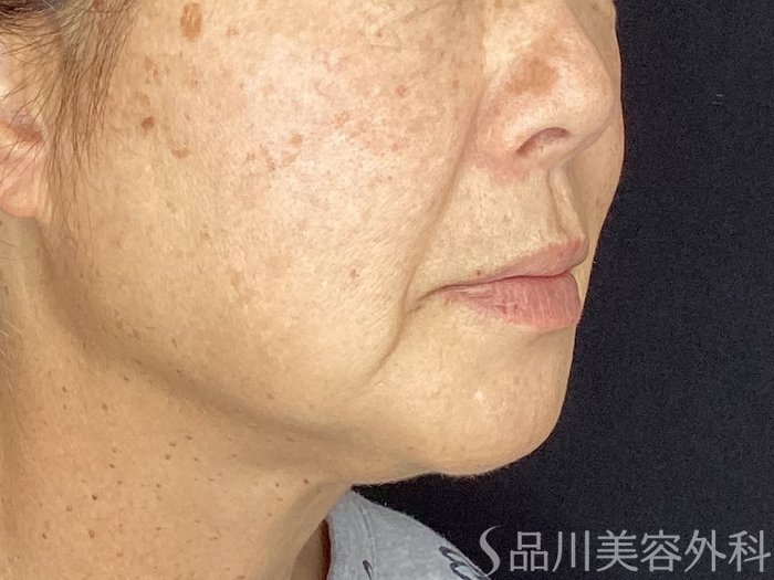症例NO.67788のBEFORE写真