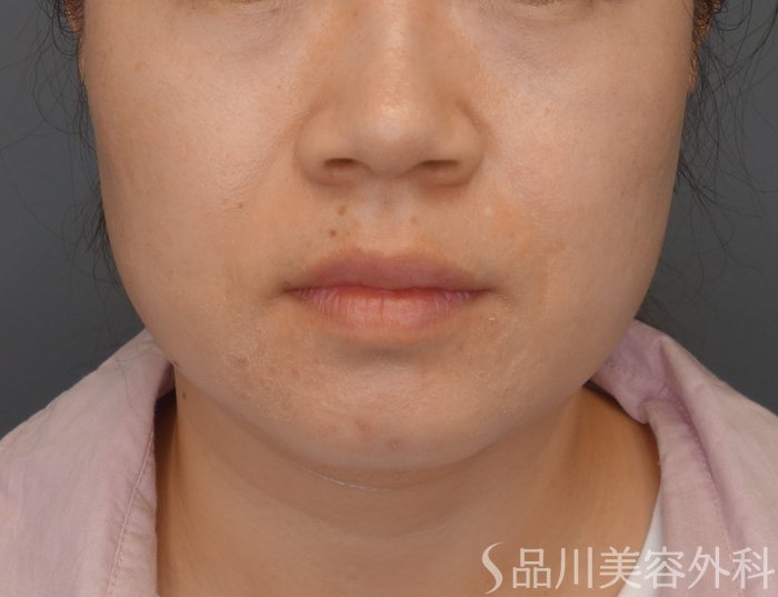 症例NO.74568のBEFORE写真
