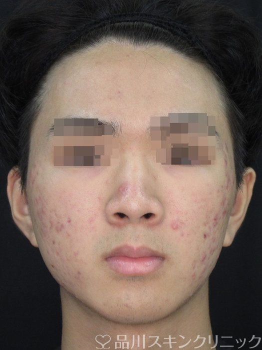 症例NO.73058のBEFORE写真