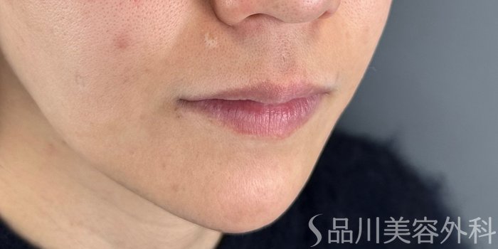 症例NO.69649のBEFORE写真
