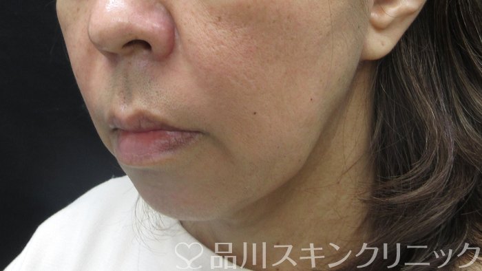 症例NO.70507のBEFORE写真