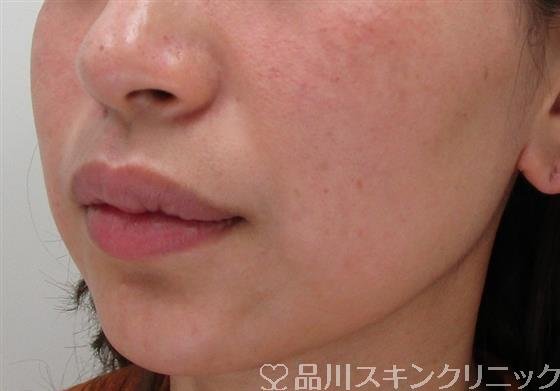 症例NO.31860のAFTER写真