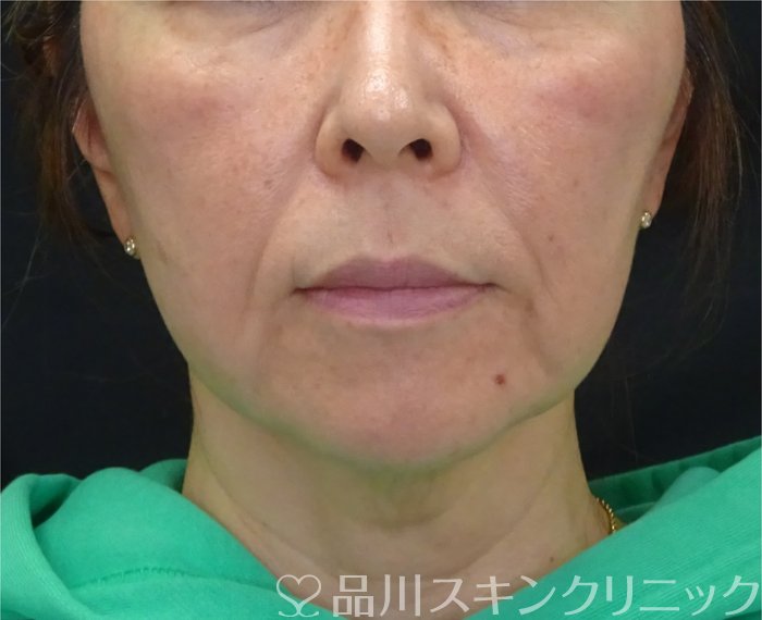 症例NO.69906のBEFORE写真
