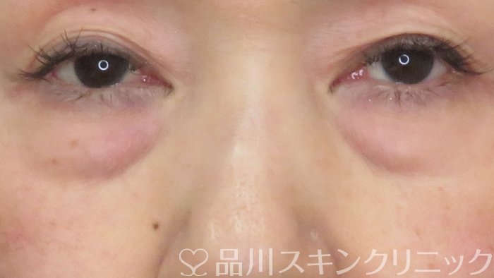 症例NO.71899のBEFORE写真