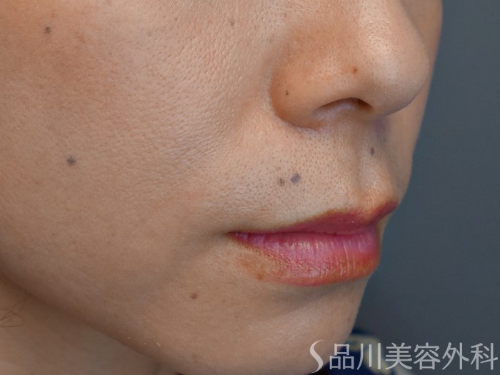 症例NO.71432のBEFORE写真