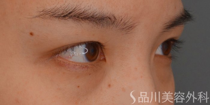 症例NO.75357のBEFORE写真