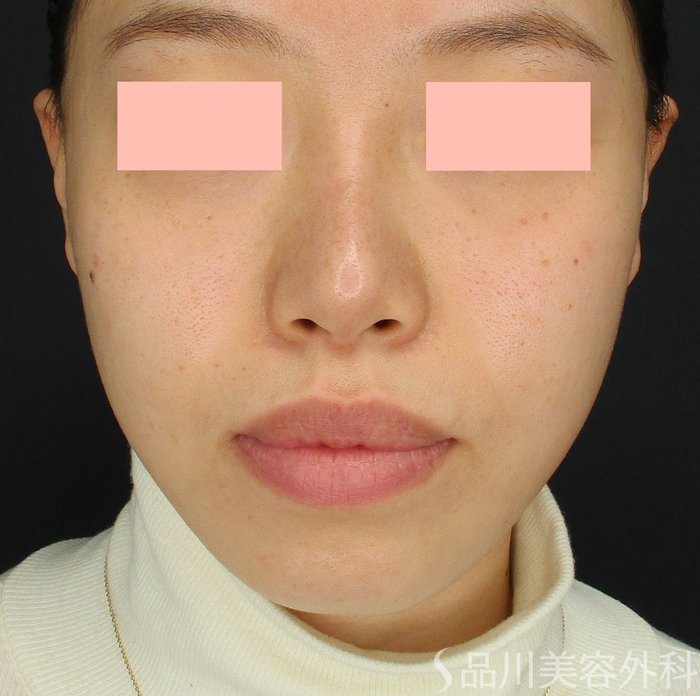 症例NO.73429のAFTER写真