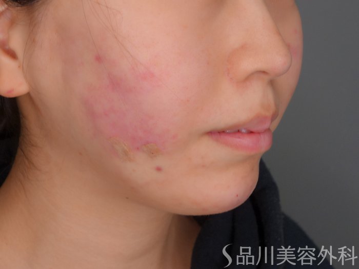 症例NO.73178のAFTER写真