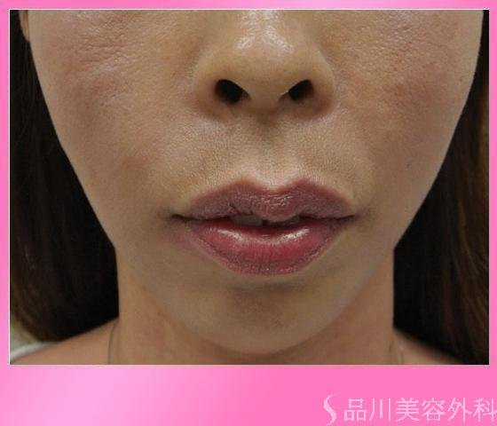 症例NO.11642のAFTER写真