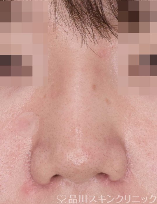 症例NO.67652のAFTER写真