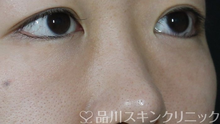症例NO.71609のBEFORE写真