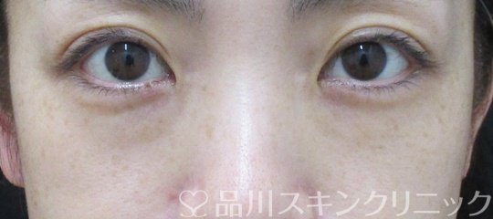 症例NO.74796のBEFORE写真