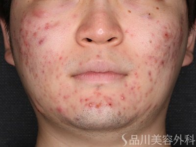 症例NO.74665のBEFORE写真