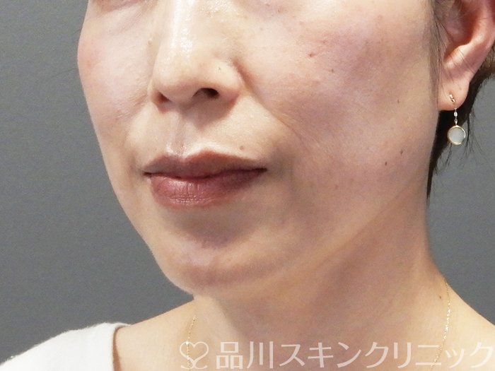 症例NO.74357のBEFORE写真