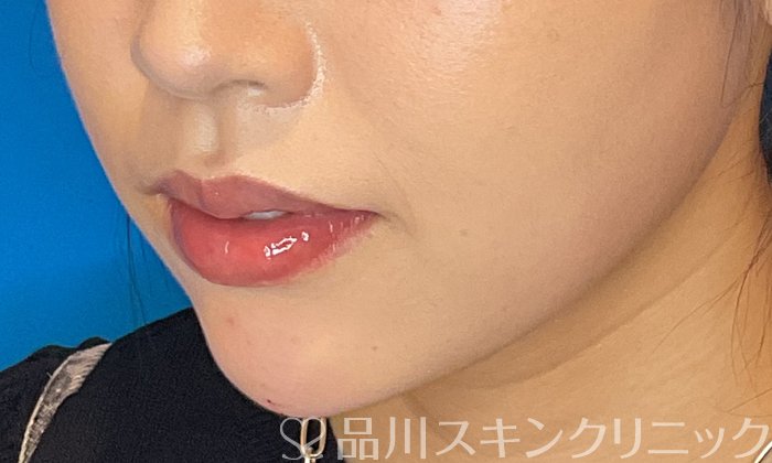 症例NO.74487のAFTER写真
