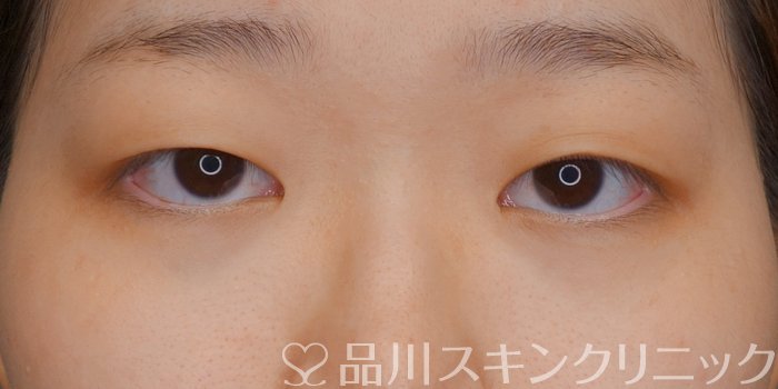 症例NO.73157のBEFORE写真