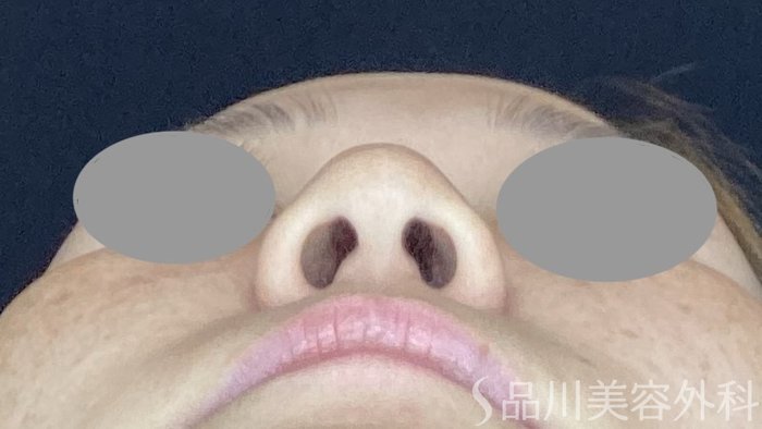 症例NO.67615のBEFORE写真