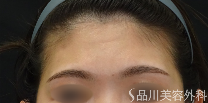 症例NO.69405のBEFORE写真