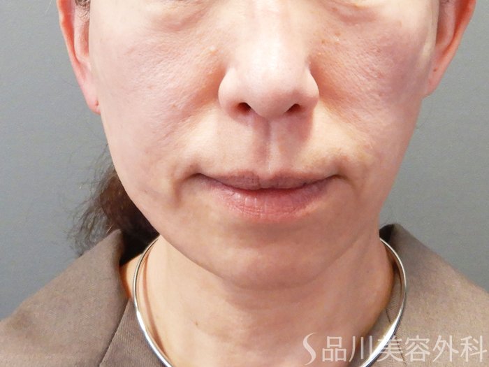 症例NO.74311のAFTER写真