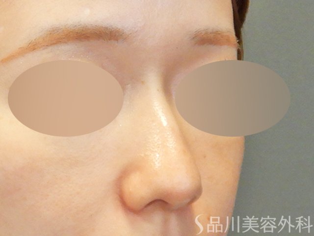 症例NO.67901のBEFORE写真