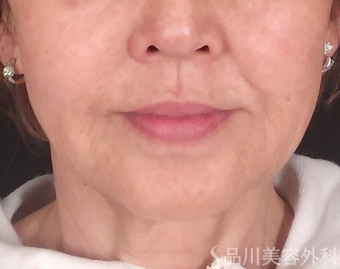 症例NO.69836のBEFORE写真