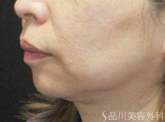 症例NO.73895のBEFORE写真