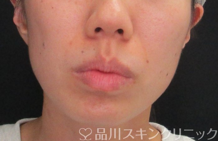 症例NO.73500のBEFORE写真