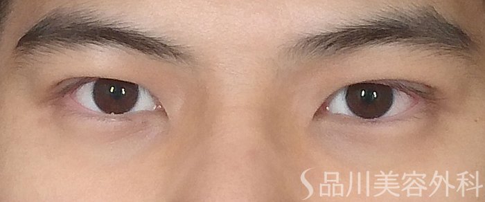 症例NO.67039のAFTER写真