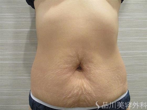 症例NO.20811のAFTER写真