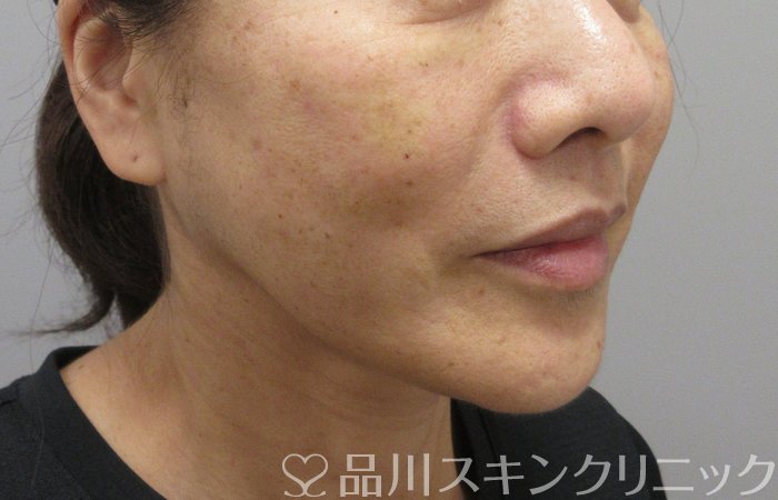 症例NO.74307のAFTER写真