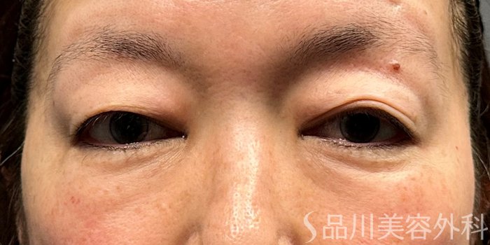 症例NO.74405のBEFORE写真