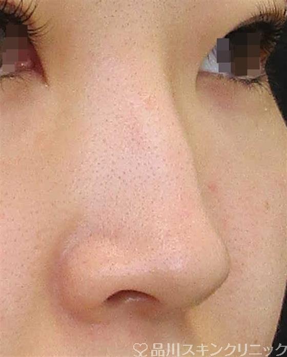 症例NO.61877のBEFORE写真