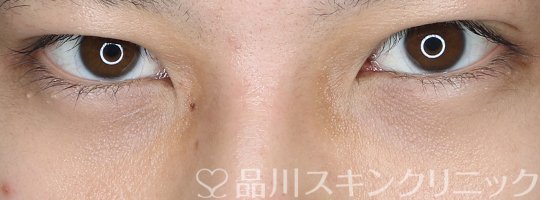 症例NO.73428のAFTER写真