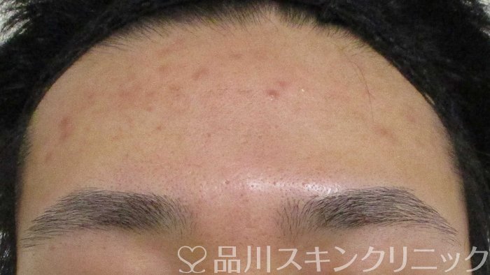 症例NO.70498のBEFORE写真