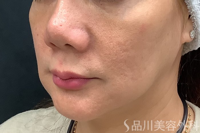 症例NO.67810のBEFORE写真