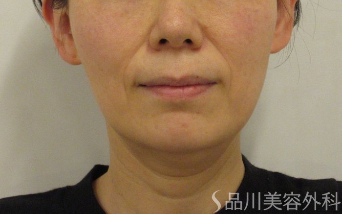 症例NO.73717のBEFORE写真