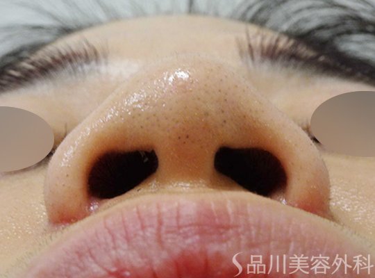 症例NO.69600のAFTER写真