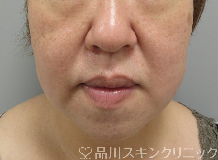 症例NO.71463のBEFORE写真