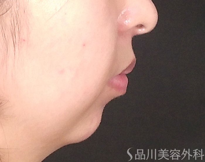 症例NO.65687のBEFORE写真